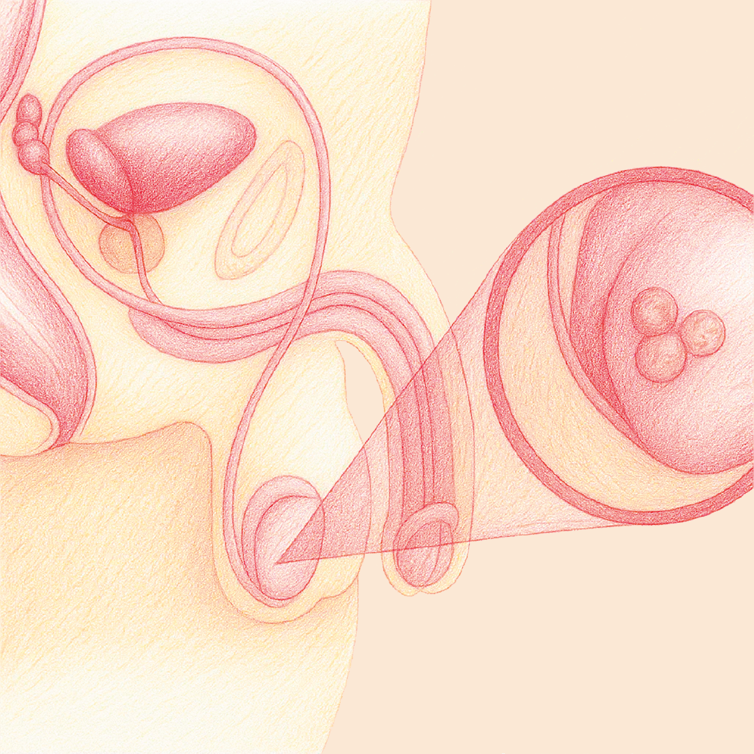 Cáncer de Testículo