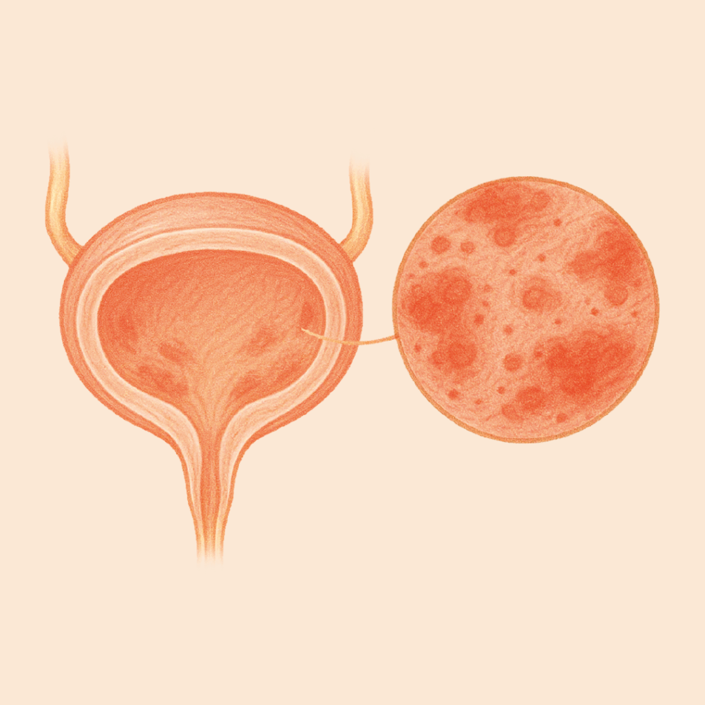 CISTITIS INTERSTICIAL