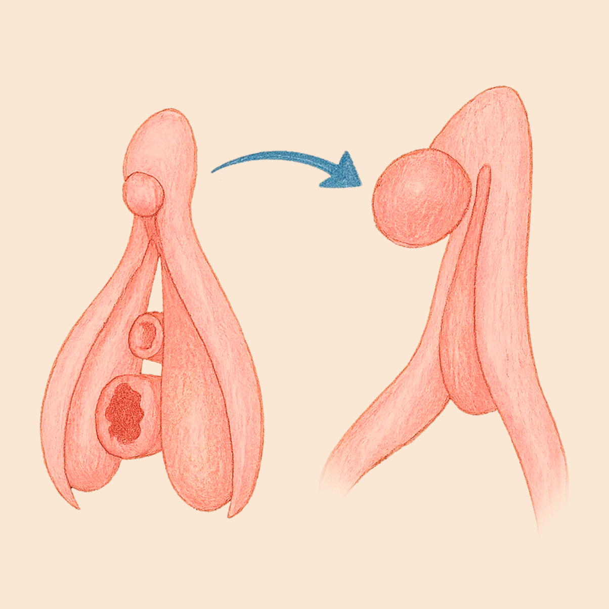 Eliminación de Verrugas