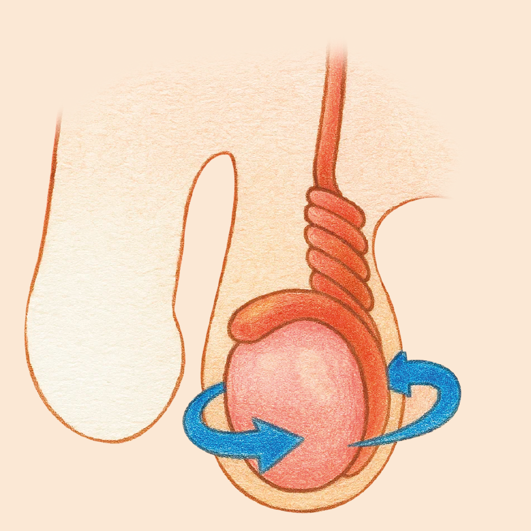 Torsión Testicular
