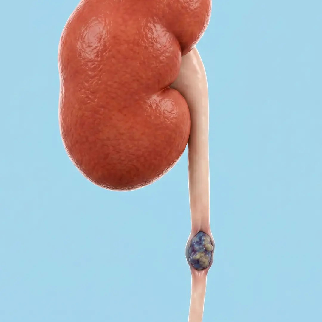 Cáncer de Uréter Lima