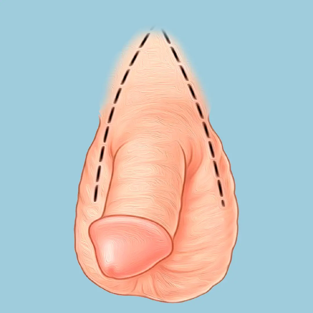Alargamiento de Pene Lima