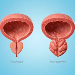prostata inflamada