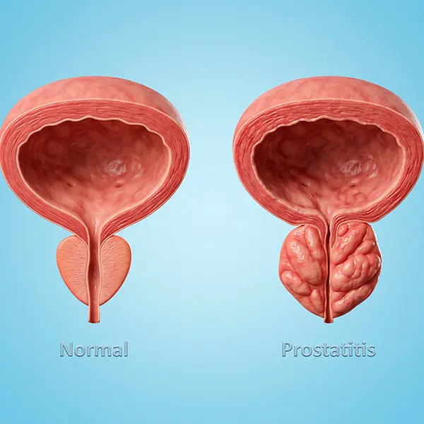 prostata inflamada