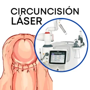 Circuncision con laser beneficios