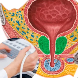 prostata inflamada lima 2026